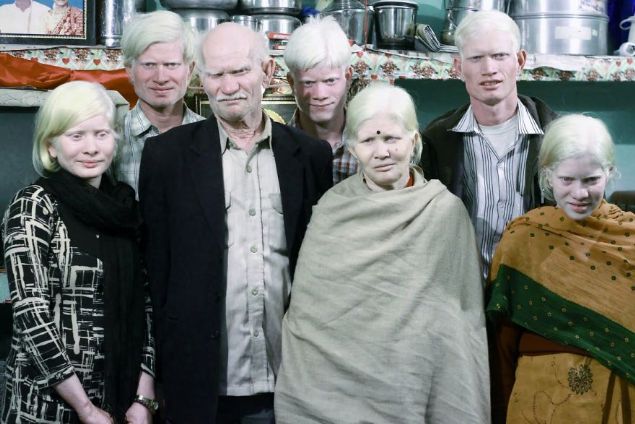 Bu aile dünyanın en büyük albino ailesi... 