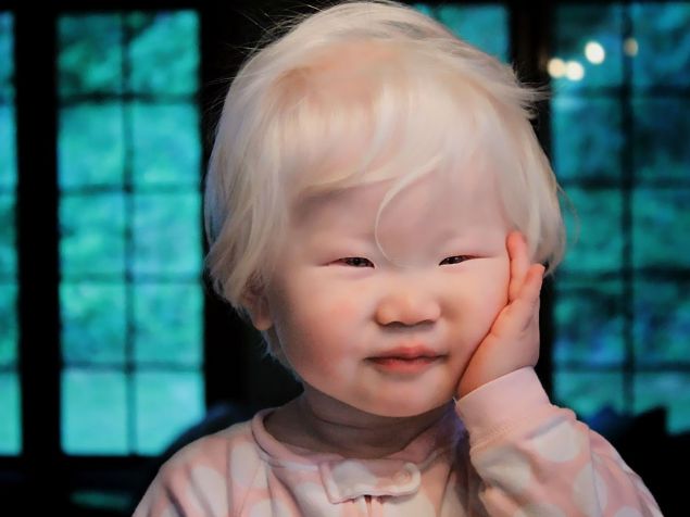  Bu hastalığı taşıyanlara albino denir.   Dünyada 17 bin kişi albino hastalığına sahip.     