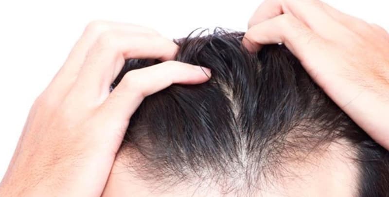 Saç dökülmesine ne iyi gelir? Saç dökülmesine karşı en etkili besinler