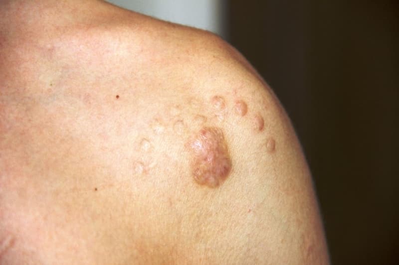 <p>�ocuklu�undan beri asker olmak isteyen Y�ld�zel v�cudundaki d�vmeleri sildirmek i�in Bodrum’da bir estetik uzman�na gitti. �lk ba�ta bir �ey anlamayan gen� her g�n d�vmelerini sildirmeye gitti. Bir s�re sonra cildi ��r�meye ba�layan Y�ld�zel b�y�k ac�lar �ekmeye ba�lad�. Yakla��k 8 ay boyunca ac� �eken Y�ld�zel daha sonra �nl� bir estetik cerrahla g�r��t�. V�cudundaki d�vmelerin bulundu�u omuzu, bilekleri ve kollar�ndaki izlerin kal�c� oldu�unu duyunca hayat�n�n �okunu ya�ad�.&nbsp;</p>