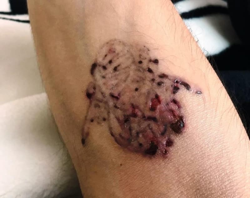 <p><b>Cildim ��r�d�</b></p><p>�ok zor g�nler ge�irdi�ini ifade eden Y�ld�zel, “Yakla��k 12 g�n sonra cildim ��r�meye ba�lad�. 12 g�n sonra derilerim ��r�m�� deh�et bir �ekilde d�vmelerin bulundu�u yer i�eri ��kt�. Ac�s� ve �st�rab� anlat�lacak gibi de�ildi. Ciddi bir �st�rap �ektim. Ben �ocuklu�umdan berri hayalim olan �zel Harekat�� olabilmek i�in bu i�lemleri yapt�rd�m.</p>