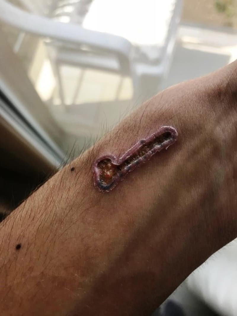 <p>Fiziksel ac�y� hesaba bile katm�yorum. G�nlerce put gibi uyudum. T�rkiye’nin hi�bir yerinde d�vme sildirmeye gidildi�inde dermapen uygulayan doktor daha bulamazs�n�z. Bu kadar s�k�nt�l� s�re�lerden ge�tim ve cezalar�n� �ekmesini istiyorum” dedi.</p>