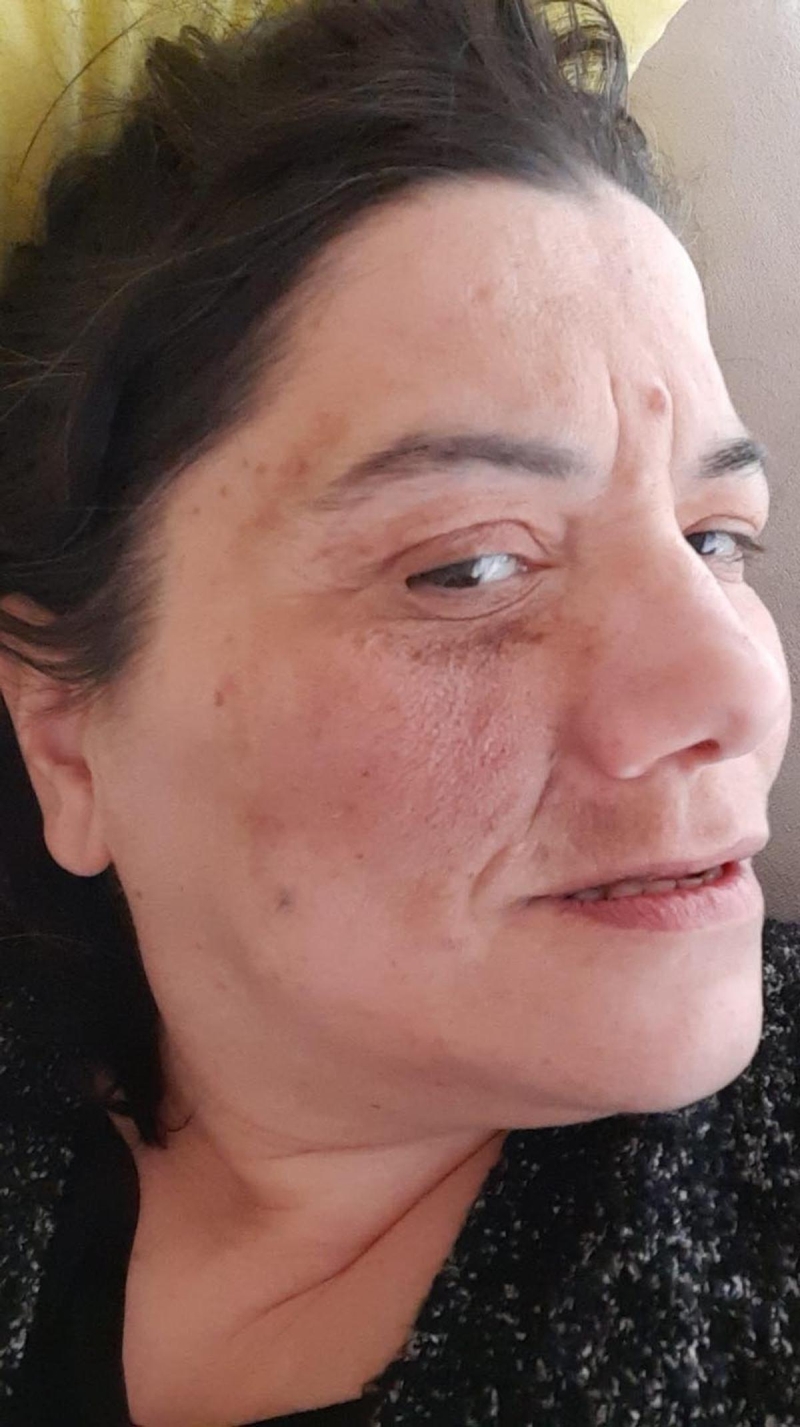 <p><b> 'T�M G�N A�RI VE YANMA �LE U�RA�IYORUZ'</b></p><p>Doktorun kendilerine e�inin a�r�lar�ndan kurtulaca��n� ifade etti�ini s�yleyen �zer Demirli, 'Bize 'Y�zde 90 oran�nda bu a�r�lardan kurtulacak' dediler. �ok az bir uyu�ukluk kalacak ama bak�n ne hale geldi. Bana y�z�n�n karar�p, ��r�y�p bu hale gelece�ini s�ylemediler. T�m g�n a�r� ve yanma ile u�ra��yoruz. E�ime uyu�turucu ila�lar vermeye ba�lad�lar. Y�z felci, o nedenle konu�makta zorlan�yor. Sosyal hayat�na devam edemiyor, konu�am�yor, hi�bir �ey yapam�yor. Sadece t�m g�n bu a�r� ile u�ra��yor. Yemek yiyemiyor, psikolojimiz, huzurumuz, her �eyimiz bozuldu. Nefes almakta bile zorlan�yor. �la� i�ip b�t�n g�n uyuyor, uykusunda bile a�l�yor. Biz e�imin hastal���n�n ara�t�r�lmas�n� ve tedavi edildikten sonra eski haline gelmesini istiyoruz' diye konu�tu. </p>