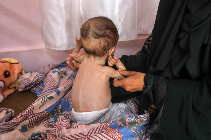 <p>Han Yunus kentinde bulunan Nasır Hastanesi ve Deyr el-Belah'taki Aksa Şehitleri Hastanesinde çaresiz annelerin kucaklarındaki bitkin ve zayıf çocuklar AA kameramanı tarafından görüntülendi.</p>