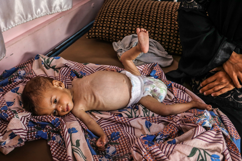 <p>Hala kısıtlı imkanlarla da olsa hizmet veren hastanelerde yetersiz beslenme vakalarındaki artış göze çarpıyor.</p>