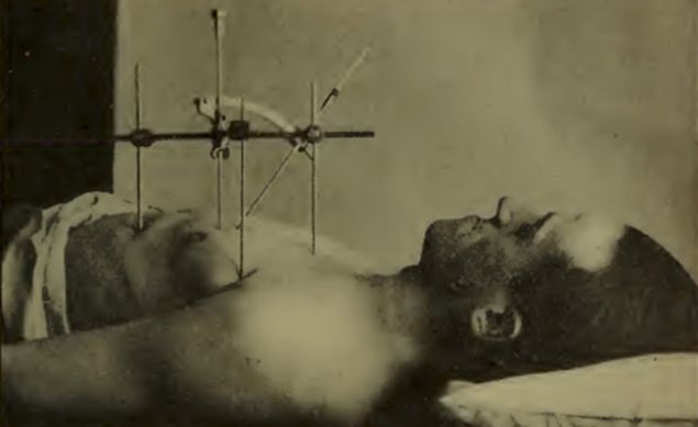 Hirtz Pusulas� Resimdeki alet, yaral�ya saplanan kur�unun yerini tespit etmek amac�yla kullan�l�yordu.     