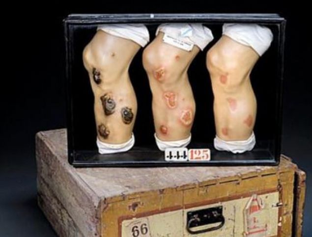 Frenginin sonu�lar�n� g�steren �� balmumu bacak, Almanya; 18.y�zy�l  Frenginin bacaklar� ne hale getirdi�ini g�steren bu �� balmumu bacak, s**ks yapmadan �nce bir kez daha d���nmenize neden oluyor. Doktorlar ve halk sa�l��� uzmanlar�n�n frenginin yay�lmas�n� engellemek amac�yla uygulad��� bu y�ntem, insanlar� frenginin sonu�lar�yla kar�� kar��ya b�rak�yor. 