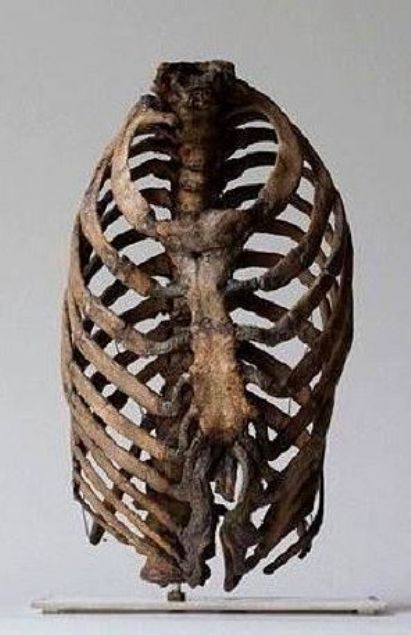 Korsenin Zarar�  Bayanlar�n daha ince bir v�cuda sahip olmak i�in kulland�klar� korseler kaburgalar� s�k��t�rarak �l�mlere yol a��yordu. 