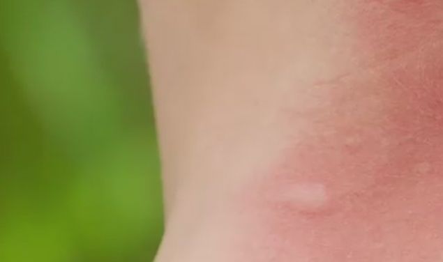 Sivri sinek srndan sonra cilt kabarmalarna ve kantlarna iyi gelecektir...  