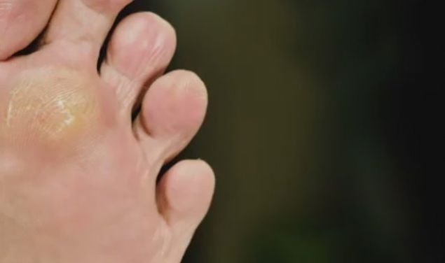       Eer nasrlarnzdan ikayetiyseniz muz kabuu ile bir ka gnde halledebilirsiniz.  