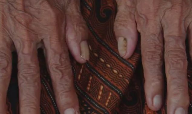  Cilt krklklarn gidermek iin doal yntemlerden bir tane daha.       