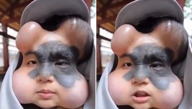  Yaplan para yardmlar sonras ameliyat olan Yan, imdi yeni yzyle mutlu gler yayor. 