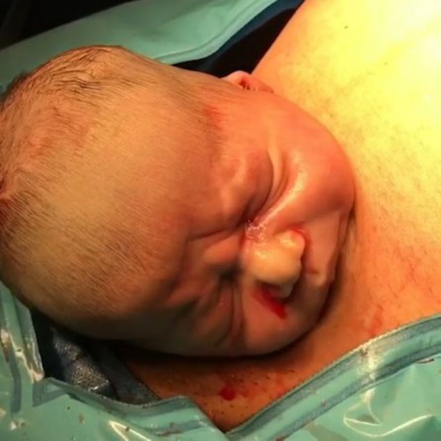   Daha sonra �ngiltere'de d�nyaya gelen bu bebek mucize olarak adland�r�ld�. Do�um esnas�nda kameralara yans�yan o anlar herkesi �oke etti. Bebe�im sa�l�kl� oldu�u bilgisi ise herkese rahat nefes ald�rd�.      