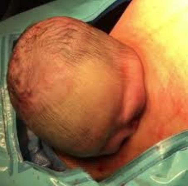   Karn� a��lan kad�n�n mutlaka do�um yapmas� bekleniyordu. Doktorlar ise g�rd�kleri kar��s�nda �oke oldular. Annesi bayg�nl�k ge�iren bebek anne karn�ndan kendi kendine ��kmaya ba�lad�. Doktorlar� bile �oke eden bu olay t�p tarihine ge�ti.     