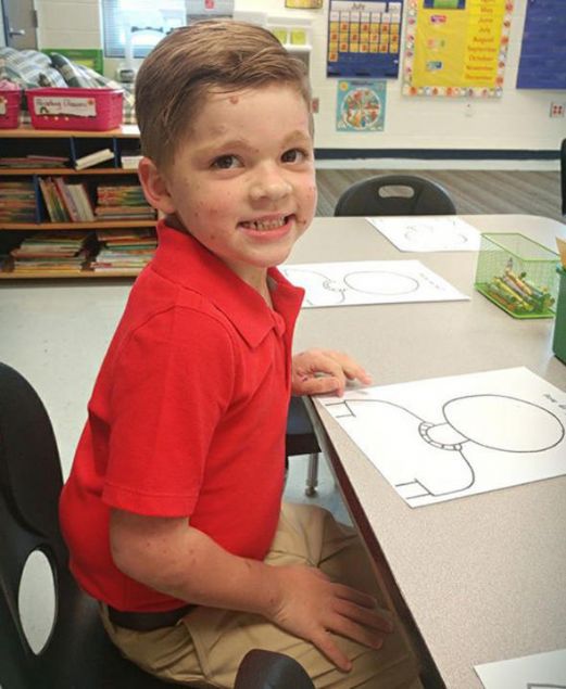  Ge�irdi�i 26 farkl� operasyon ve nakil ile �ocu�un s�rt�nda do�um lekesinin yar�s� al�nd�.   