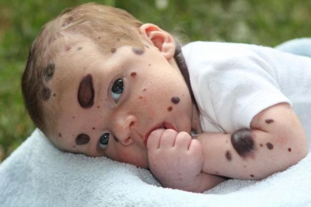 Newsner'in haberine g�re, bebe�e konulan konjenital melanositik nev�s tan�s� nedeniyle bebe�in v�cudunun % 80�i siyah lekelerle kapl�yd�.    