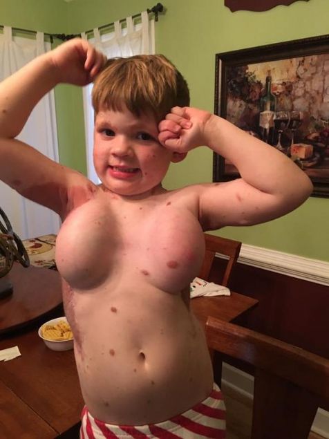  Dylan��n s�rt�ndaki leke �ok b�y�kt� ve cerrahlar tamam�n� almak istiyorlard�. Ancak kolay bir operasyon olmayacakt�. Bebe�in v�cudunun ba�ka bir b�l�m�nden al�nan deri, s�rt�na nakledilecekti.   