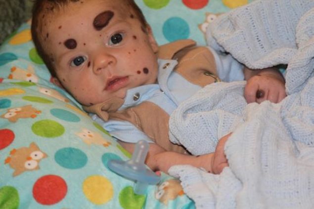  Konjenital melanositik nev�s ile d�nyaya gelen bebekler b�y�d�klerinde cilt kanseri olabiliyor. Bu nedenle do�um izlerine dikkat etmekte fayda var.   