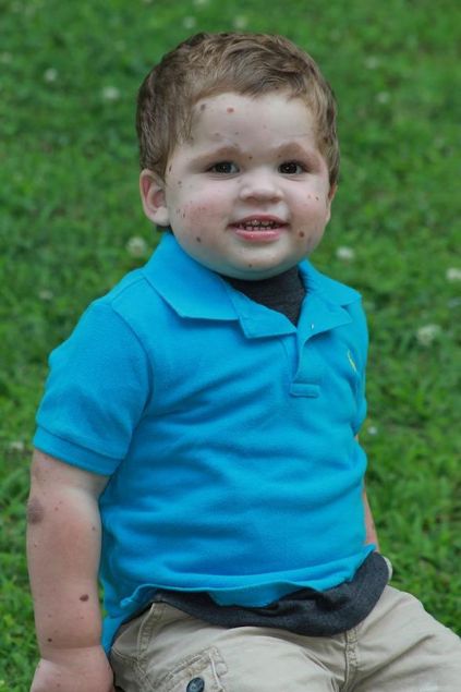  Annesi Kara, Telegraph�a �Tek �midimiz lekelerin b�y�memesi. B�y�mesi halinde cilt kanseri olma riski varm��. Her 3-6 ayda bir operasyon ge�iriyor� dedi.   