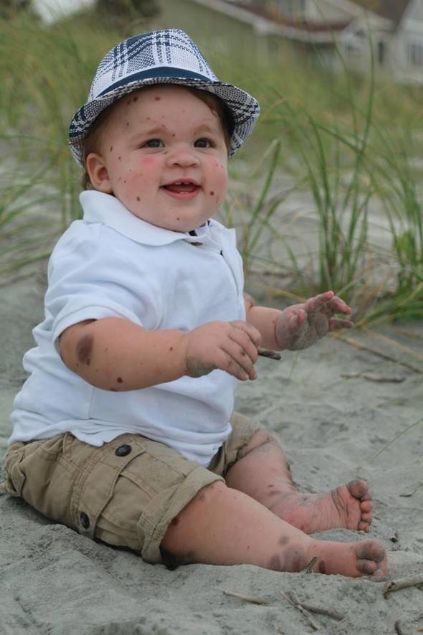  V�cuduna yap�lan nakiller nedeniyle Dylan'�n cildinde �i�likler olu�maya ba�lad�. �i�likler ne kadar b�y�k olursa o kadar iyiydi. B�ylelikle buradan al�nan deri s�rt�na nakledilebilecekti.   