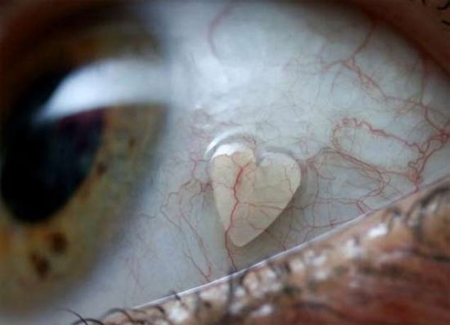  G�ze yerle�tirilen platin kalpGER�EK      