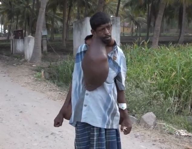 34 y�ldan beri talihsiz adam sa� boynunda ve kollar�nda 18 kilo a��rl���ndaki t�m�rlerle ya��yor.    