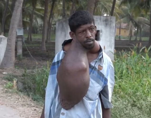 12 ya��ndan beri bu t�m�rlerle bo�u�an adam, �enesinin alt�ndaki 8 kilo a��rl���ndaki t�m�r nedeniyle konu�makta g��l�k �ekiyor.      