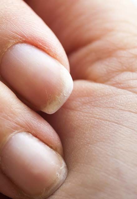 Trnakta deiimler: Parmak ularna yeterli kan gitmediinde trnak planzn boyutunda bymeler meydana gelir. Trnaklarnzn ekli eskisine gre daha kaln ve yuvarlak ise damarlarnzda problemler olabilir.      