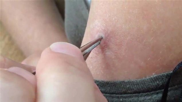 Yarann iinden kan tropikal blgede yaayan ve larvalarn deri altna brakan botfly cinsi sinekti.  