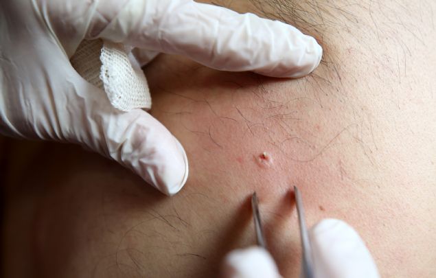 AP�TERAP� K�MLERE UYGULANMAZ?  <br><br>  Apiterapi kimlere yap�labilece�ini anlatan I��k, '18 ya��n� doldurmu� olmas� gerekir. Kanama, p�ht�la�ma bozuklu�uyla seyreden bir kan hastal���n�n olmamas� gerekiyor. Kontrol alt�na al�namayan kalp damar hastal���n�n olmamas� gerekiyor.    