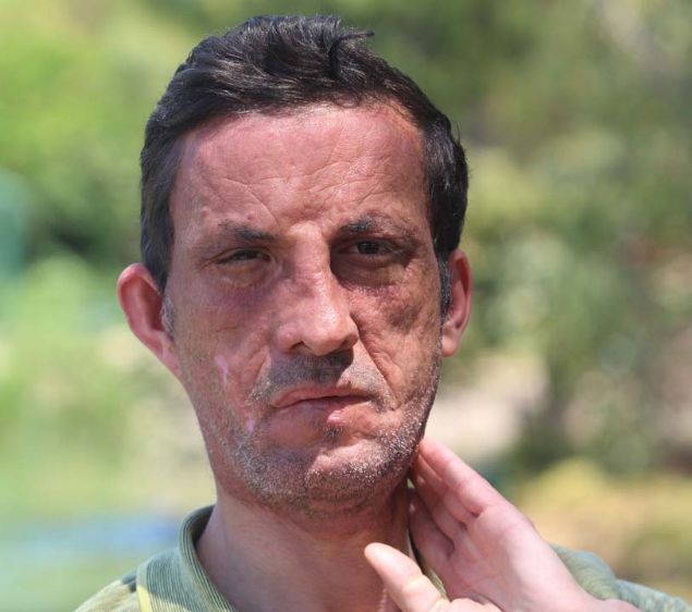 Akdeniz niversitesi Tp Fakltesi Plastik Rekonstrktif ve Estetik Cerrahi Anabilim Dal retim yesi Prof. Dr. mer zkan ile ekibi tarafndan gerekletirilen yz nakliyle yeni bir yze kavutu.    