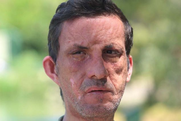 Manavgat ilesi Gebece kynde, 1 aylkken evde kan yangnda yznn yzde 90'nda yank nedeniyle kalc hasar meydana gelen 26 yandaki Uur Acar'n hayat, 21 Ocak 2012 tarihinde gerekletirilen Trkiye'nin ilk yz nakli operasyonu ile deiti.    