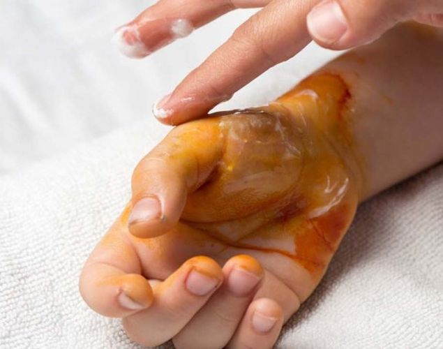 -Yaraya imsak vaktinden nce konan sv ilacn, imsak vaktinden sonra emilmesi   