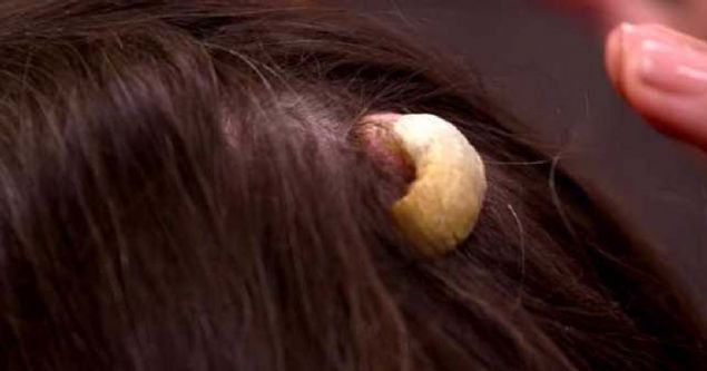 Be yldr nianl olan Lisa, yaklaan evlilik nedeniyle bir mddet bekledi. Sonrasnda fiziksel ve duygusal olarak yaad zorluklar anlatmak iin Dr. Lee'ye gitti. Bu cilt sorunundan kurtulmak istiyordu.        