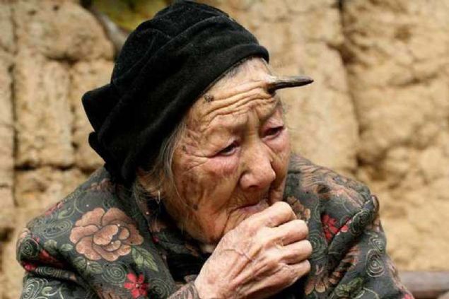 2010 ylnda 101 yandaki Zhang Ruifang adnda inli teyzenin alnndan birden bire boynuz kt. Doal olarak ailesi, akrabalar, komular hatta tm dnya oke oldu.      