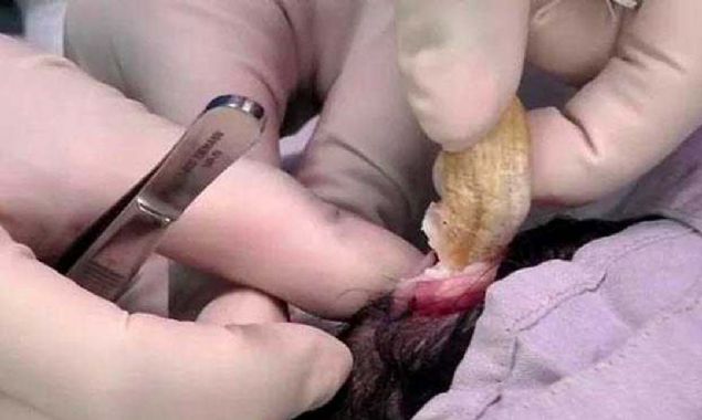 Neyse ki, Dr. Lee ameliyata gerek kalmadan ilii ortadan kaldrabildi.      