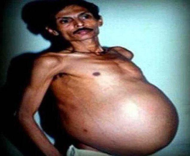 Hindistan'n Nagpur kentinde yaayan Bhadat isimli adam byk gbeinin sra dlnn hep farknda olduunu iddia etmesine karn, 1999 ylnda scak bir yaz gecesi, nefes alamaz hale gelene kadar doktora gitme ihtiyac duymam.   <br><br>  Hastaneye gittiinde hayretler iinde kalan doktorlar karnnda hi domam bir bebek olan ocuu buldular. Bu Bhagat'n tam olarak gelimemi ve iinde kurum haline gelmi ikiz kardeiymi.       