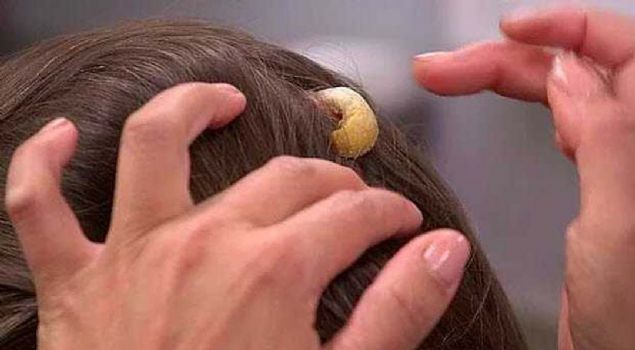 ilik Lisa'nn bekledii kadar tehlikeli olmasa da, bykl doktoru alarma geirdi. 'Olduka fazla uzam bir trnaa benziyordu. Daha nceleri de cilt boynuzu grmtm. Ama bu boyutta bir cilt boynuzunu ilk kez gryorum.'      