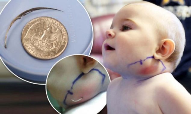 Bebein yananda 1,5 cm uzunluunda bir para ku ty kmtr. Bu ty alan doktorlar aile ile grtklerinde bebein ku ty yastkta yattn renerek bebein bu paray yastktan yuttuunu ve yanan alt ksmn yerleerek bebein yanan i ve dtan deldiini sylemilerdir.   