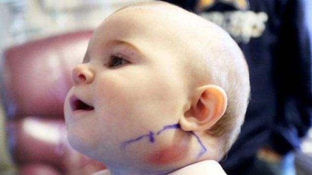 Daha sonra Mya, Hutchinson, Kansas'ta bir hastaneye yatrlm ve doktorlar kk bebein lenflerinde stafil enfeksiyonu olduunu dnmlerdir.   <br><br>  Ama hastanede, Mya'nn bykannesi, enesinin iki kat byklndeki ilik zerinde bir sivilce olduunu fark etmitir.    