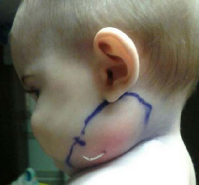 Bunun zerine doktorlar sivilceyi yok etmek iin tekrardan antibiyotik tedavisine balamlardr.  <br><br>  Eve geri dnen aile bu sefer yanaktan sivri bir parann ktn grnce bebei tekrar doktora gtrdklerinde bebein yanandan kan paraya ok olmulardr.  