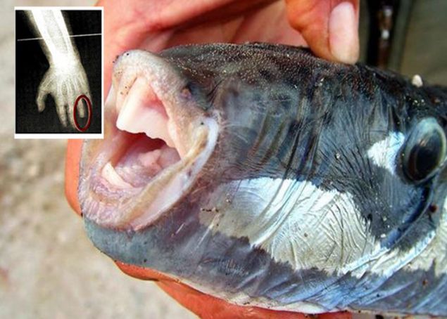 Ailesiyle memleketi Anamur'un Kaledran kyne giden 8 yandaki E.B.D.'nin sol el yzk parmann son boumu, bu balk tarafndan kopartld.    